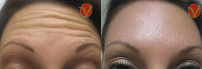 Dysport before and after photo
