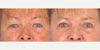 Eyelid Surgery before and after photo