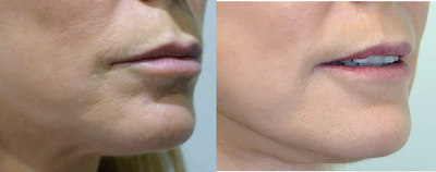 CO2 Laser before and after photo