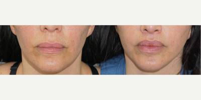 Lip Lift before and after photo