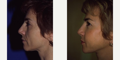 Nonsurgical Facelift before and after photo