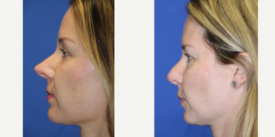 Rhinoplasty before and after photo
