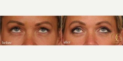 Deep Plane Facelift before and after photo