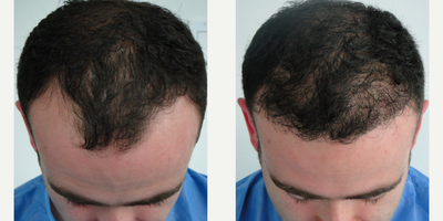 FUE Hair Transplant before and after photo