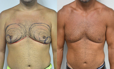 Gynecomastia Surgery before and after photo