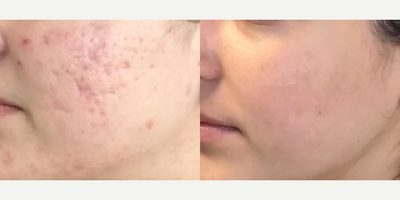 Microneedling before and after photo
