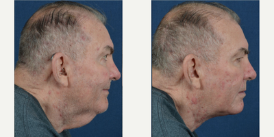 Neck Lift before and after photo