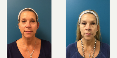 Bellafill before and after photo