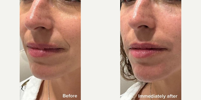 Belotero before and after photo