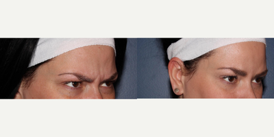 Botox before and after photo