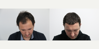 FUE Hair Transplant before and after photo