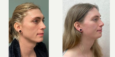 Genioplasty before and after photo
