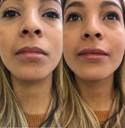 Lip Fillers before and after photo