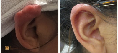 Scar Removal before and after photo