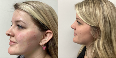 AviClear before and after photo