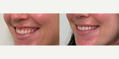 Botox for Gummy Smile before and after photo