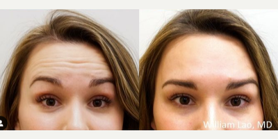 Botox before and after photo