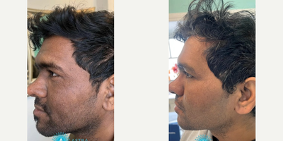 Chemical Peel before and after photo