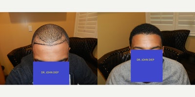 FUE Hair Transplant before and after photo