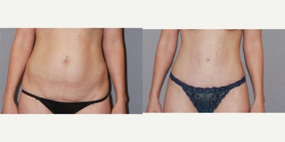 Liposuction before and after photo