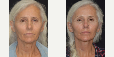 Mini Facelift before and after photo