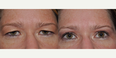 Ptosis Surgery before and after photo