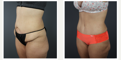 Tummy Tuck before and after photo