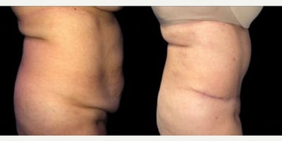 Tummy Tuck before and after photo