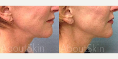 Ultherapy before and after photo