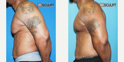 Vaser Liposuction before and after photo