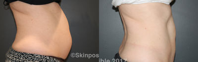 CoolSculpting before and after photo