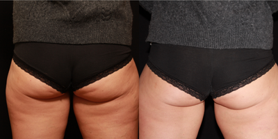CoolSculpting before and after photo