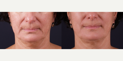 before and after image