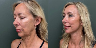 Eyelid Surgery before and after photo