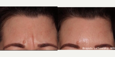 Botox before and after photo