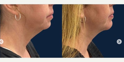 Buccal Fat Removal before and after photo