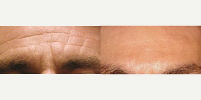 Botox before and after photo