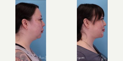 Chin Implant before and after photo