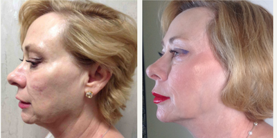 Microneedling before and after photo