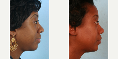 African American Rhinoplasty before and after photo
