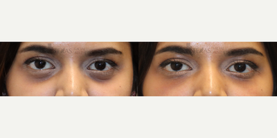 Belotero before and after photo