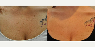 IPL before and after photo