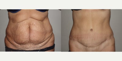 Tummy Tuck before and after photo