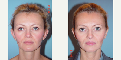 Ear Surgery before and after photo