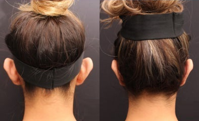 Ear Surgery before and after photo