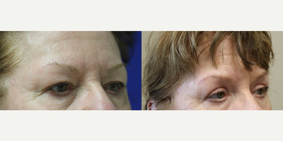 Eyelid Surgery before and after photo