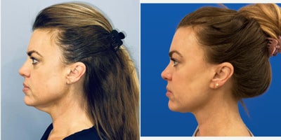 Mini Facelift before and after photo