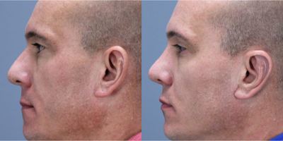 Rhinoplasty before and after photo