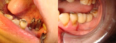 Dental Implants before and after photo
