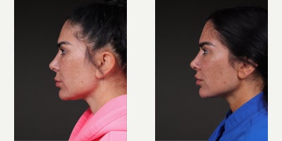 Lip Lift before and after photo